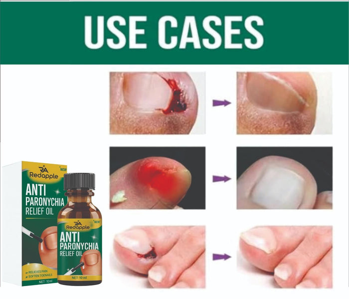 Anti Paronychia Relief Oil:  Buy 1 Get 1 Free!