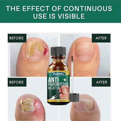 Anti Paronychia Relief Oil:  Buy 1 Get 1 Free!
